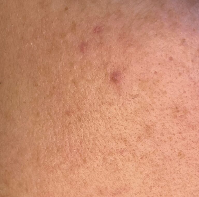 Nahaufnahme von unreiner, gebräunter Haut im Gesicht