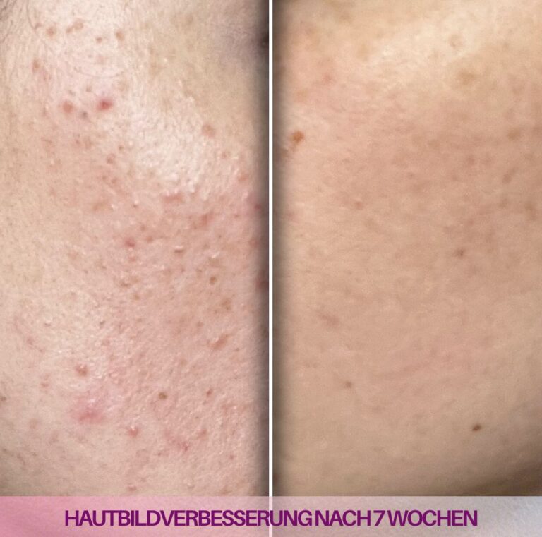 Vorher-Nachher-Foto nach 7 Wochen Nutzung des Velvetboosters