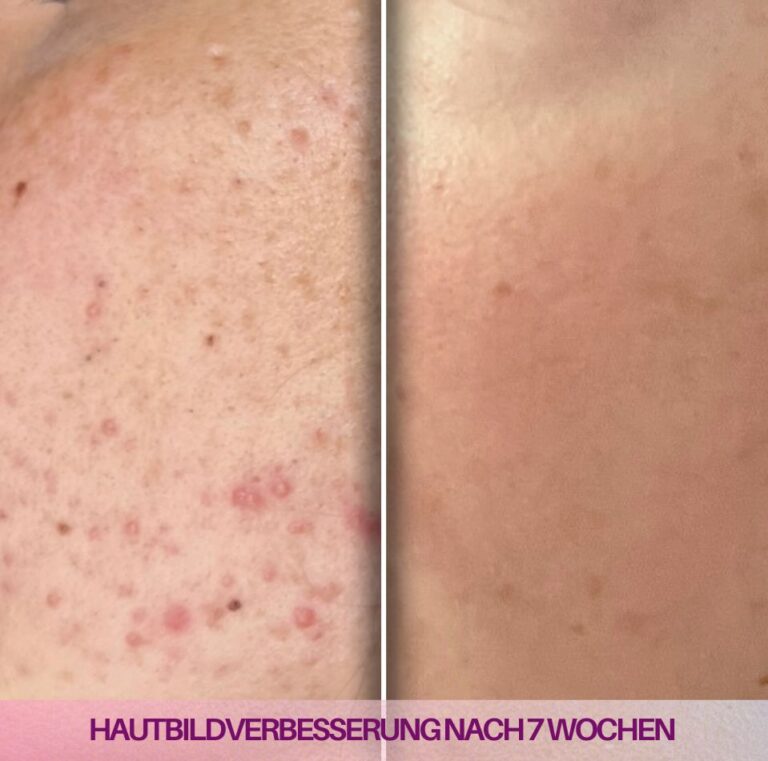 Vorher-Nachher-Foto nach 7 Wochen Nutzung des Velvetboosters