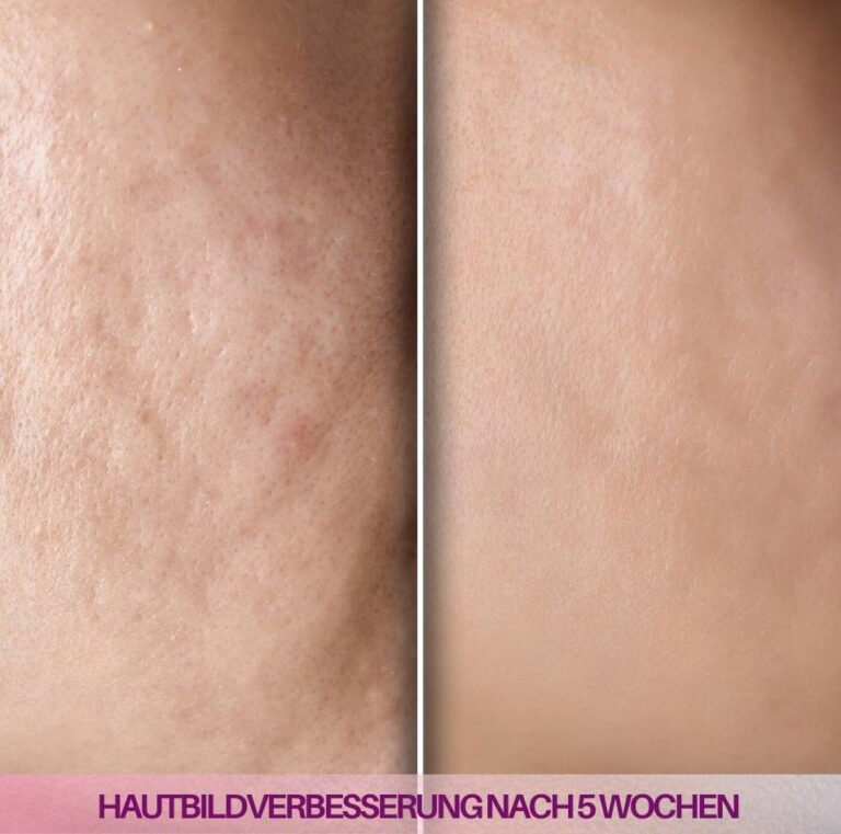 Vorher-Nachher-Foto nach 5 Wochen Nutzung des Velvetboosters